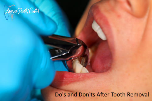Can I Drink Soda After Tooth Extraction